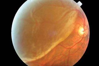 Retinal Detachment conditions treated by Dr. Nishant Kumar